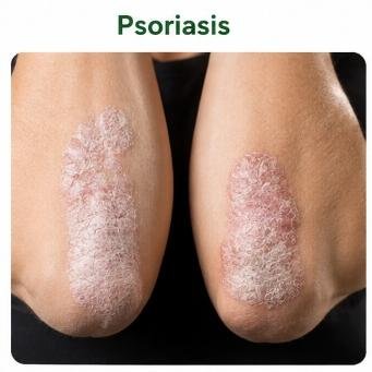 Understanding Psoriasis & Ayurvedic Care